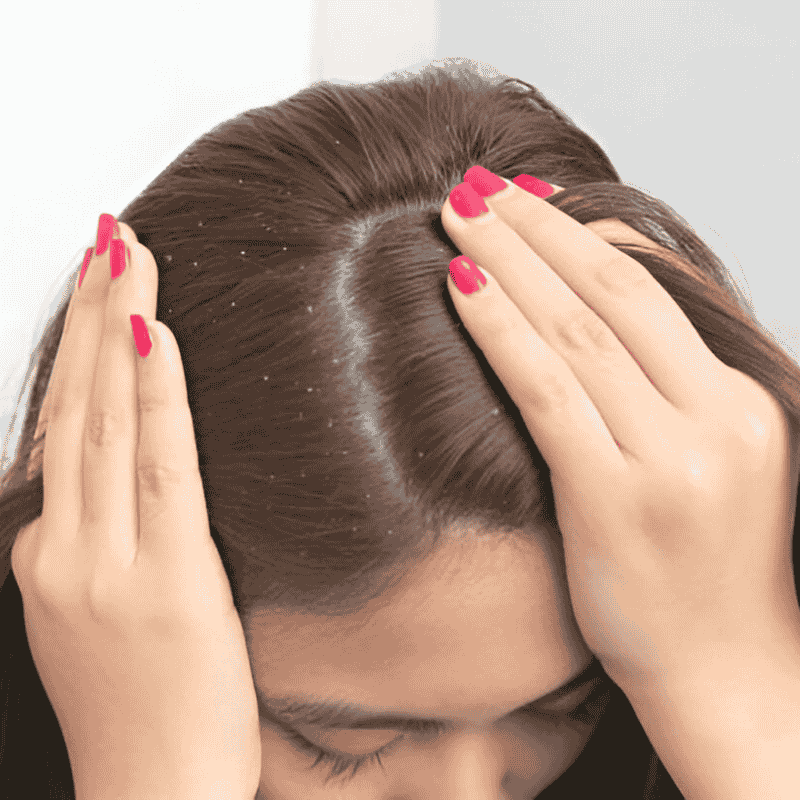 Dandruff Treatment